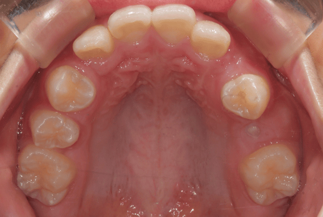 小児矯正の症例