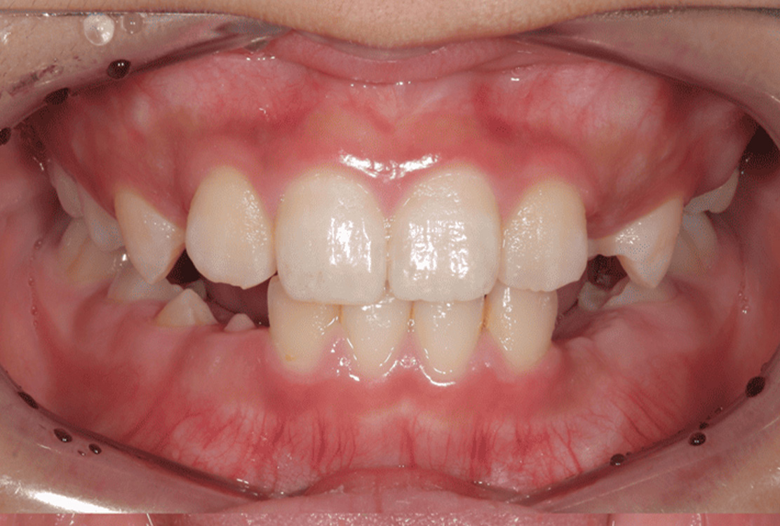 小児矯正の症例