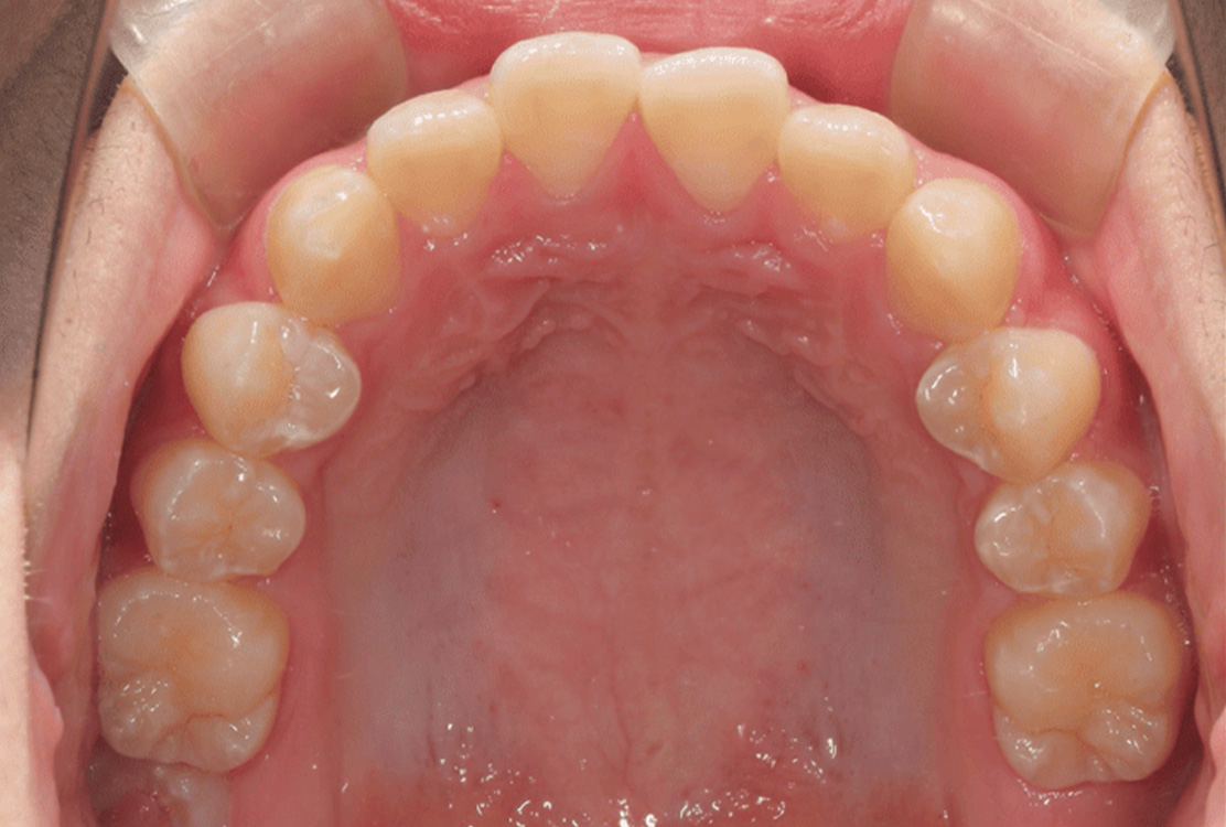 小児矯正の症例