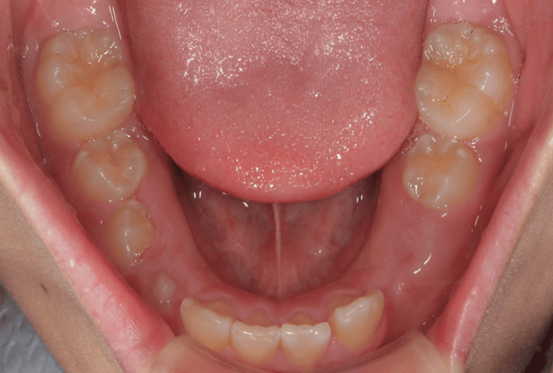 小児矯正の症例