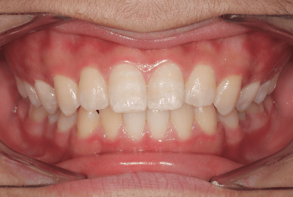 小児矯正の症例