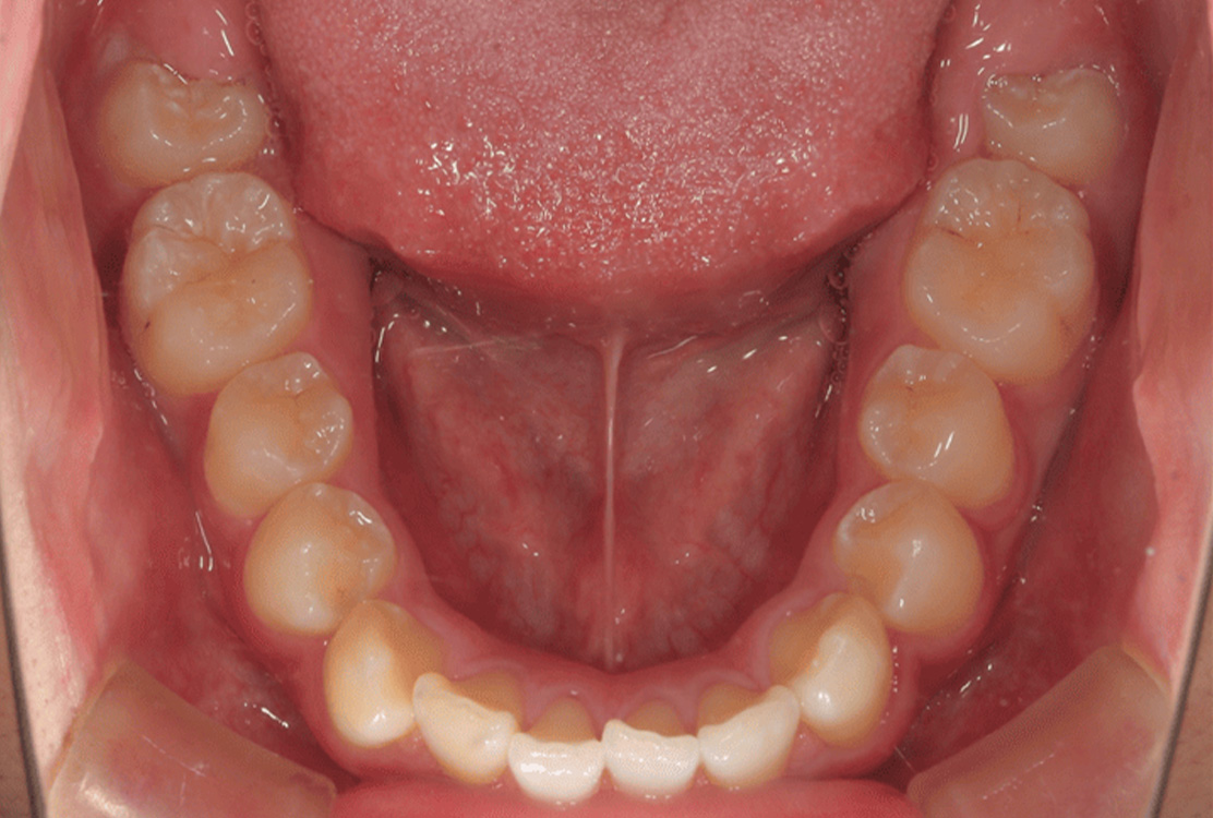 小児矯正の症例