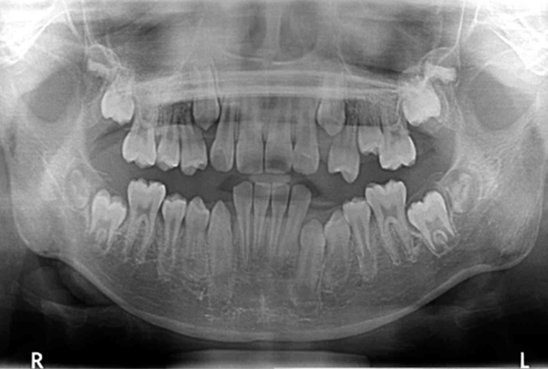 小児矯正の症例