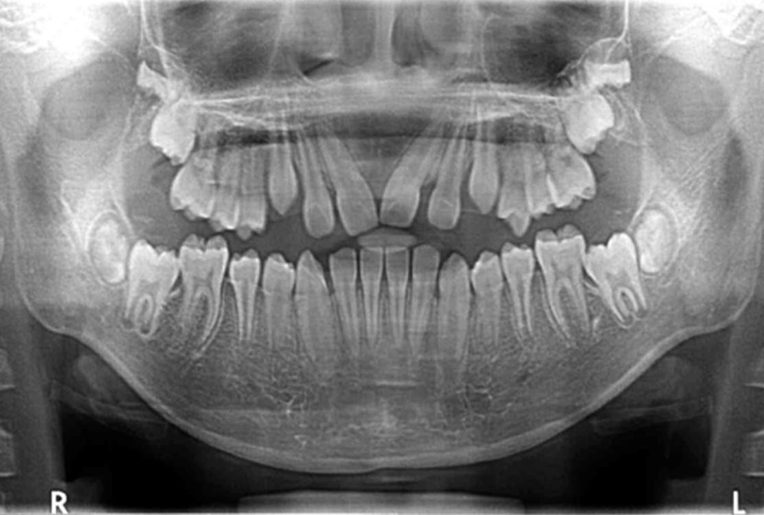 小児矯正の症例
