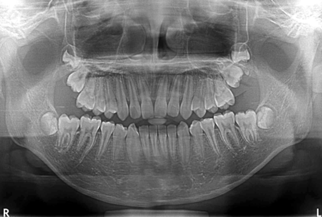 小児矯正の症例